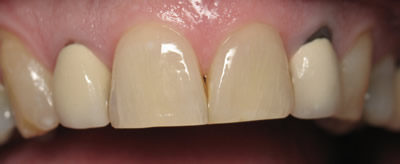 All Dental work by Dr. Thomas M. Green and Haupt Dental Lab.